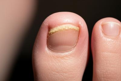 Micose de Unha: O Erro #1 Que Impede Sua Cura (Guia Definitivo)