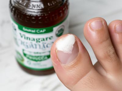 Micoses NUNCA MAIS: Hack de 30s Testado para Eliminar de Vez!