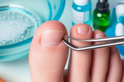 Unha Encravada: O Tratamento Caseiro Que FUNCIONA De Verdade!